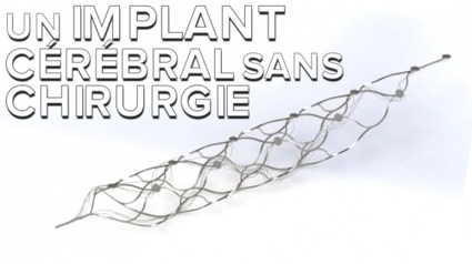 Stentrode, un implant pour contrôler des membres bioniques
